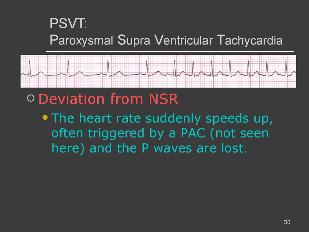 PSVT: Paroxysmal Supra Ventricular Tachycardia