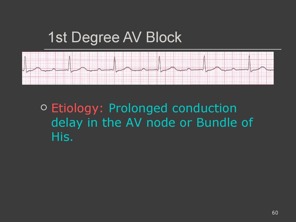 1st Degree AV Block