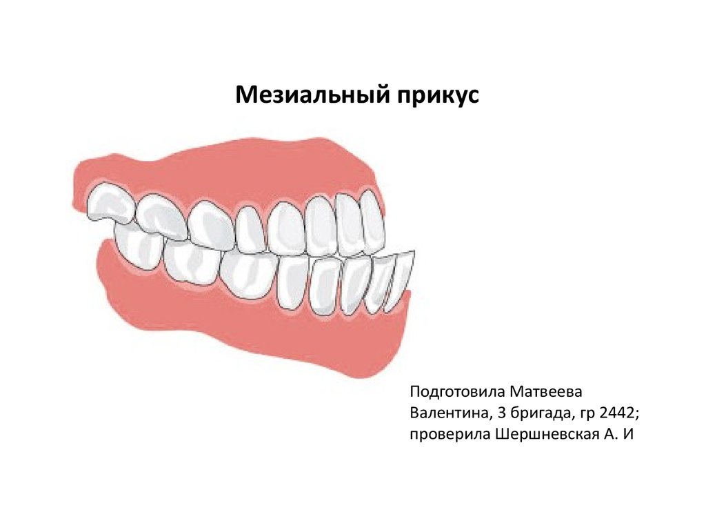 Мезиальный прикус