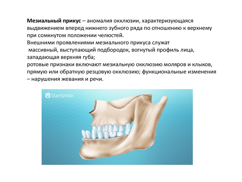 Мезиальный прикус. Мезиальный прикус презентация. Мезиальный прикус это аномалия. Мезиальный прикус классификация.