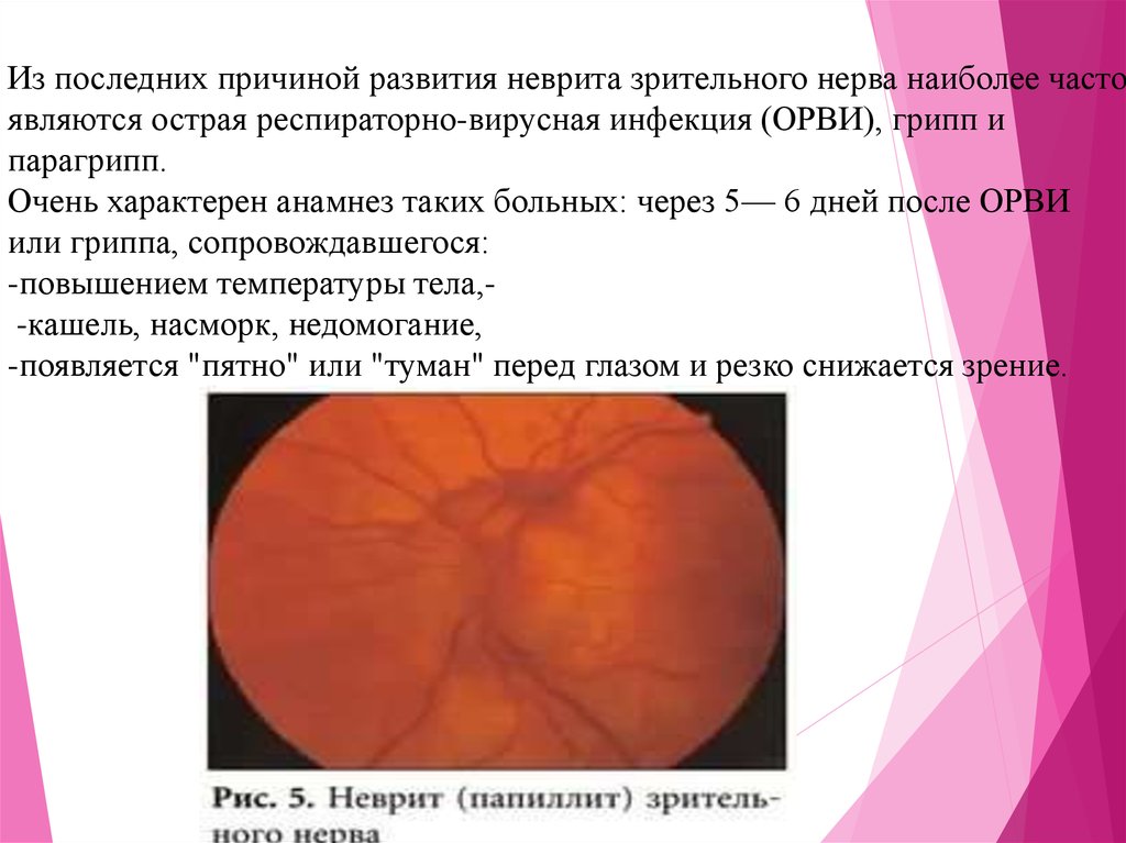 Неврит зрительного нерва. Неврит зрительного нерва инфекционный. Папиллит зрительного нерва презентация. Неврит зрительного нерва причины. Характерным признаком неврита зрительного нерва является.