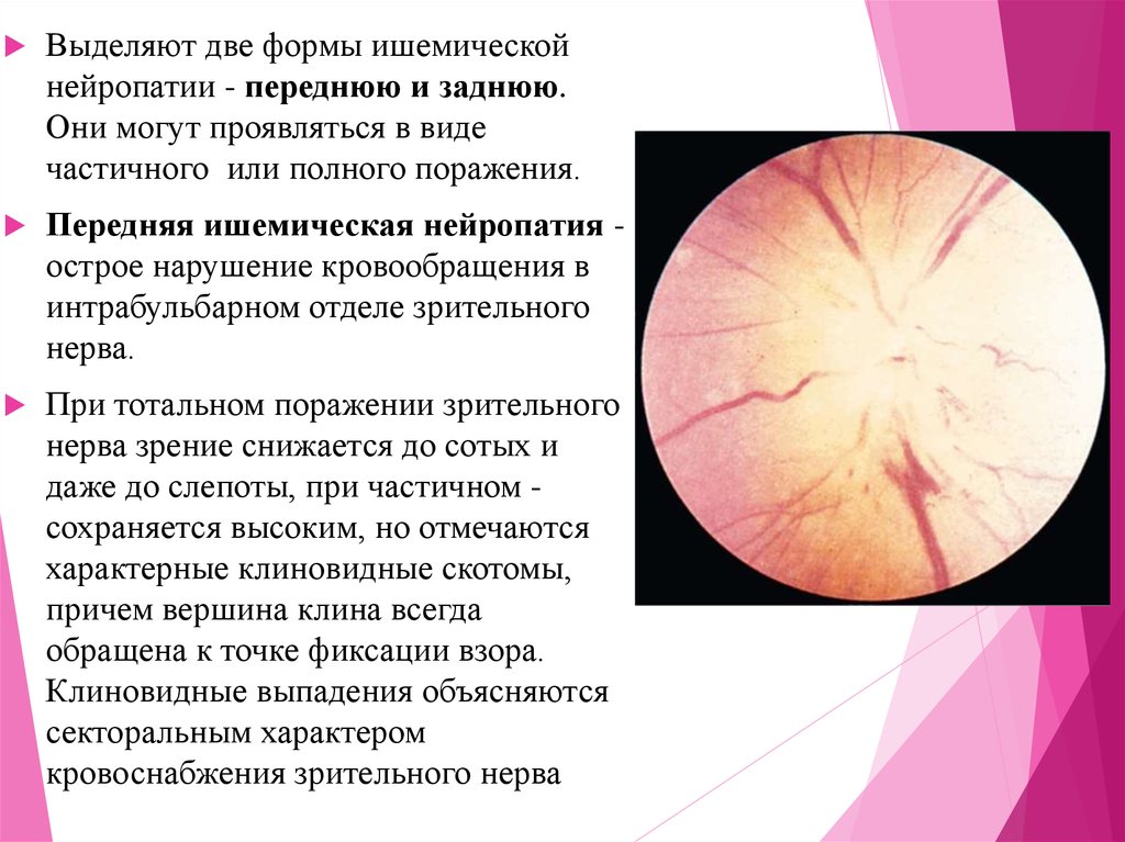 Передняя ишемическая нейропатия. Ишемическая нейропатия глазное дно. Передняя ишемическая невропатия зрительного нерва. Задняя ишемическая невропатия зрительного нерва. Интрабульбарный неврит зрительного нерва.