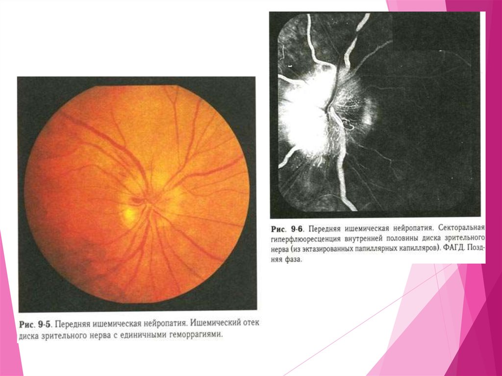 Передняя ишемическая нейропатия. Передняя ишемическая нейрооптикопатия зрительного нерва. Передняя ишемическая нейропатия глазное дно. Передняя ишемическая оптиконейропатия зрительный нерв. Ишемические нейропатии зрительного нерва.