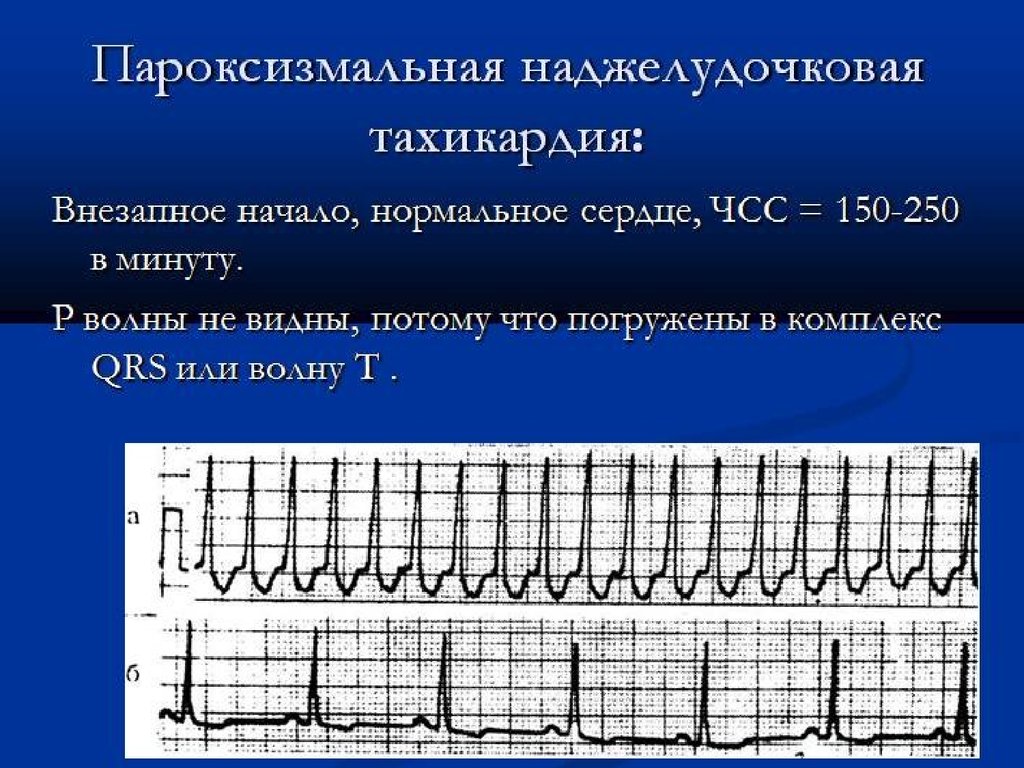 Желудочковая тахикардия лечение. Пароксизмальная наджелудочковая тахикардия ЭКГ. ЭКГ при пароксизмальной наджелудочковой тахикардии. Наджелудочковая тахикардия на ЭКГ. ЭКГ при наджелудочковая тахикардия.