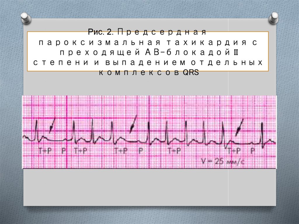 Предсердная тахикардия. Предсердная тахикардия с АВ. Предсердная пароксизмальная тахикардия с АВ блокадой 2 степени. Предсердной тахикардией с АВ-блокадой II степени. Предсердная тахикардия с АВ блокадой 2:1.
