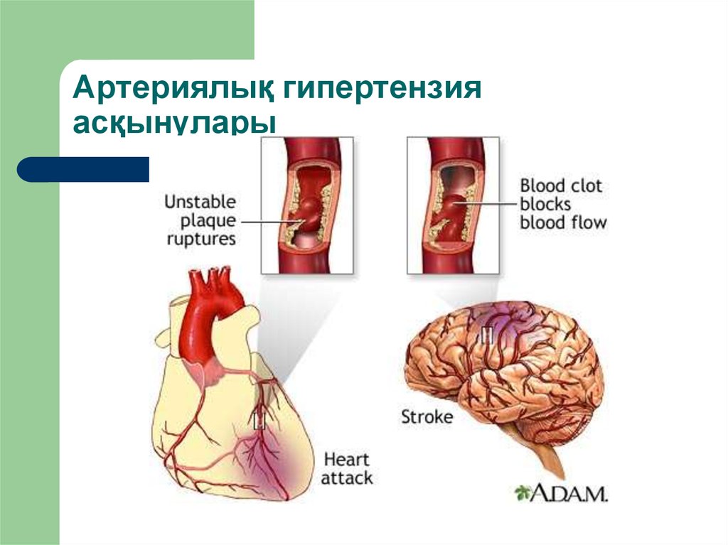 Артериялық гипертензия презентация қазақша