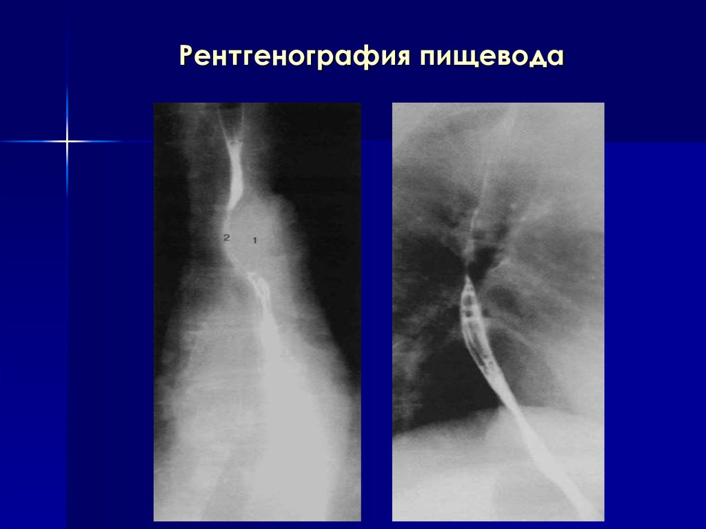 Рентген пищевода