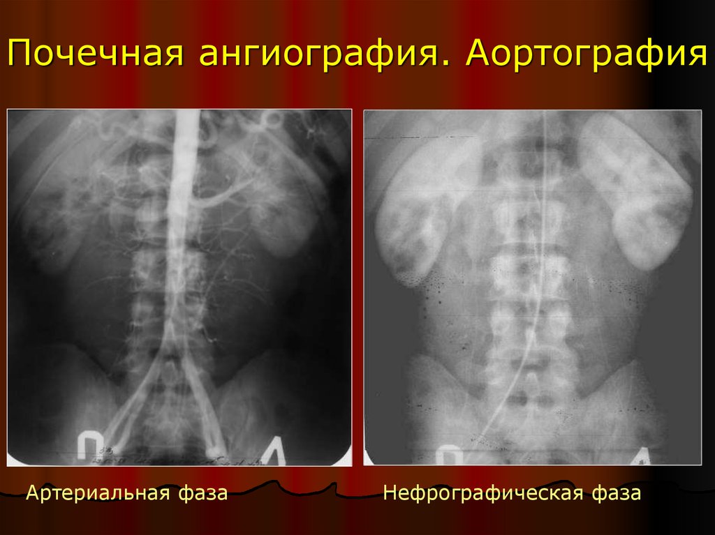 Почечная ангиография презентация