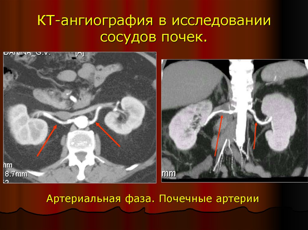 Исследование почек. Кт ангиография почечных артерий. Исследование сосудов почек.