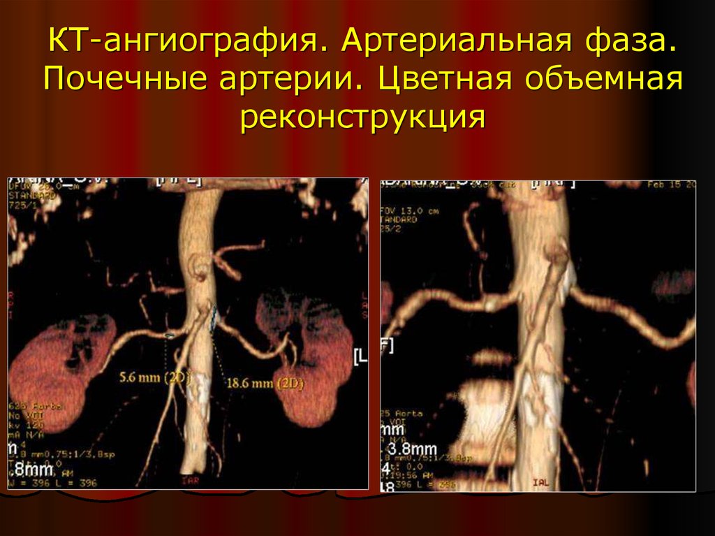 Почечная ангиография презентация