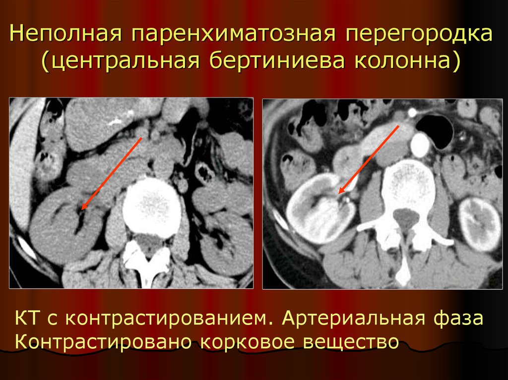 Паренхима почек состоит из. Паренхиматозная перегородка в почке что это. Паренхиматозная перемычка почки что это такое. Бертиниева колонна почки.