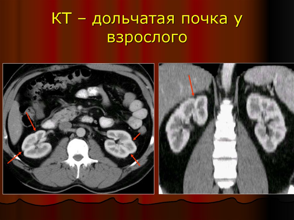 Почки взрослого. Дольчатое строение почек. Кт почек норма.