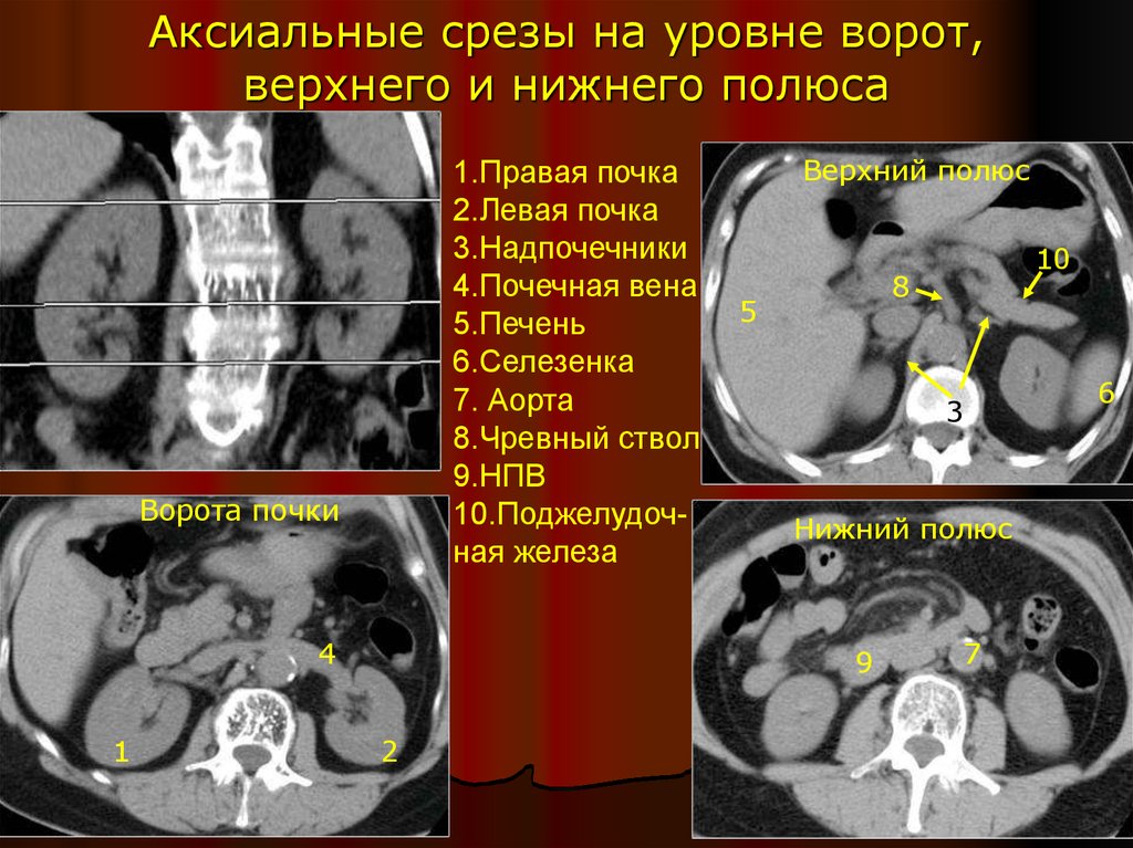 Кт картина са левой почки