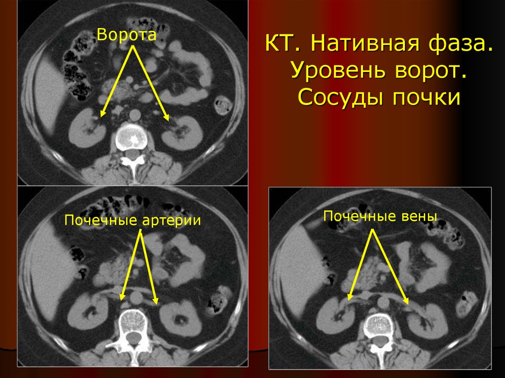 Кт картина са левой почки