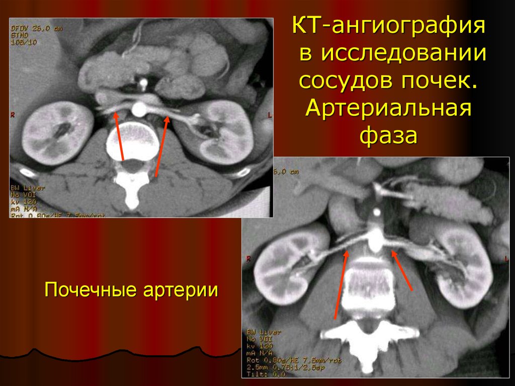 Почечная ангиография презентация