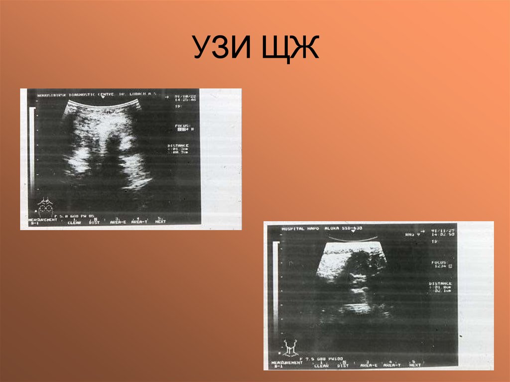 УЗИ ЩЖ