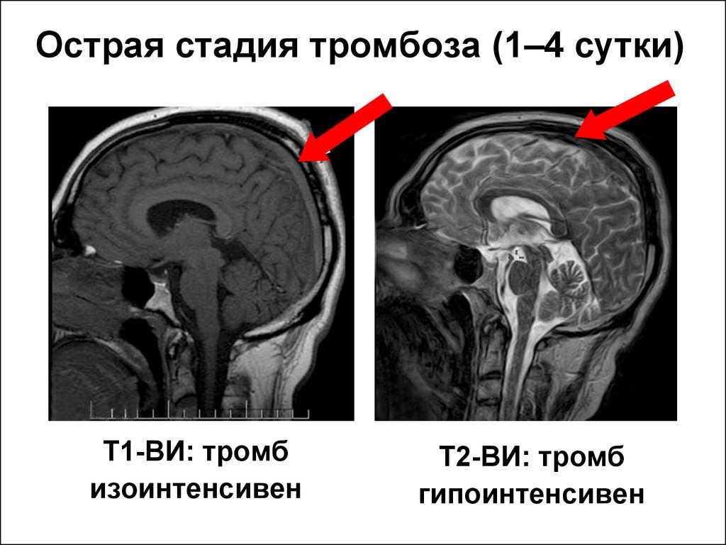 Церебрального тромбоза. Тромбоз кавернозного синуса на кт. Тромбоз синусов головного мозга кт. Тромбоз пещеристого синуса кт. Тромбоз поперечного синуса кт.