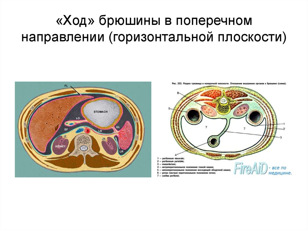 Поперечно горизонтальный. Ход брюшины в поперечном направлении. Ход брюшины в поперечной плоскости. Поперечный срез брюшины. Поперечный разрез брюшины.