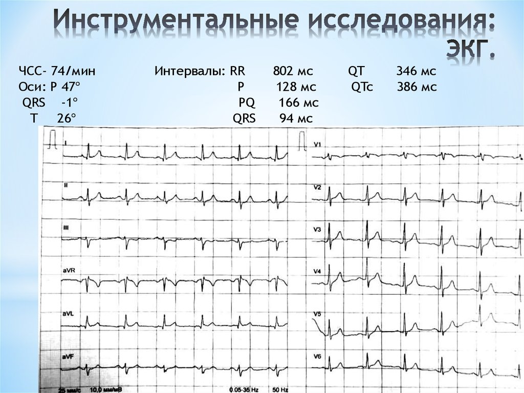 Что означает экг. ЭКГ норма p PQ QRS. Интервал r-r ЭКГ. Интервалы ЭКГ В норме таблица. Интервал PQ на ЭКГ норма в МС.