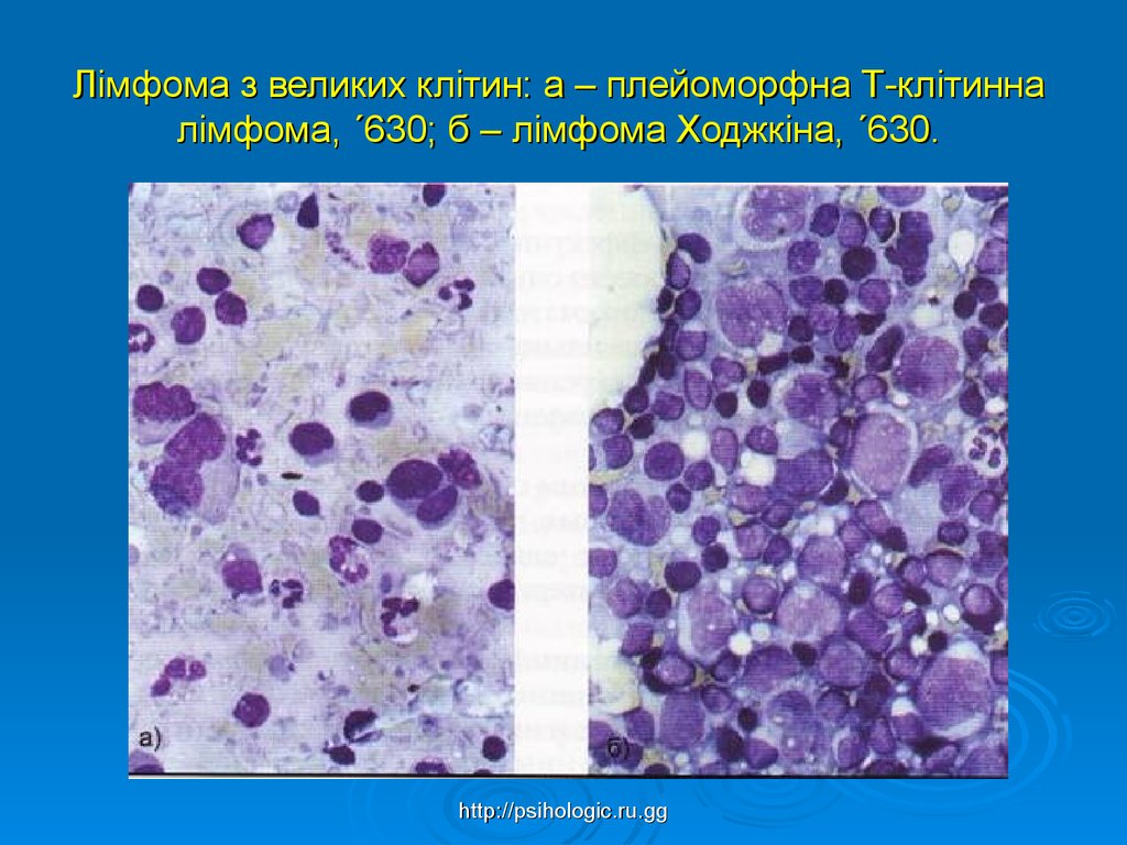 Цитологическая картина лимфомы ходжкина