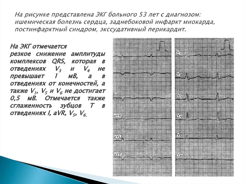 Изменение миокарда перегородочной области. Изменения на ЭКГ постинфарктный кардиосклероз. ЭКГ постинфарктный кардиосклероз заключение. ЭКГ пост ИНФАРКТНЫЙ кардио склкроз. ЭКГ постинфарктный кардиосклероз описание.