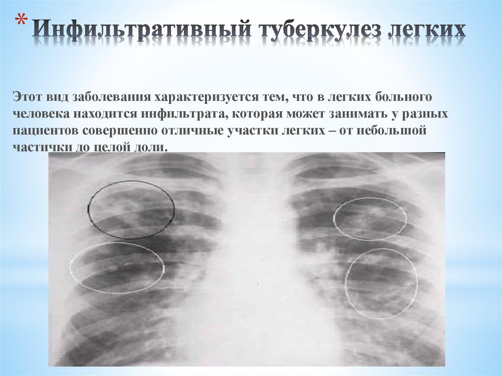 Инфильтративный распад легких. Инфильтративный туберкулез рентген. Очаговый туберкулез легких в фазе инфильтрации рентген. Очагово-инфильтративный туберкулез рентген. Инфильтративный туберкулез легкого с1-2.