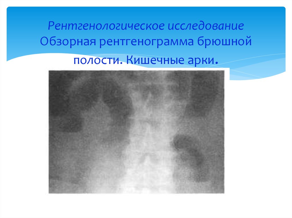 Обзорная рентгенография брюшной полости. Арки при кишечной непроходимости. Арки и чаши Клойбера на рентгенограмме. Чаши Клойбера и кишечные арки.