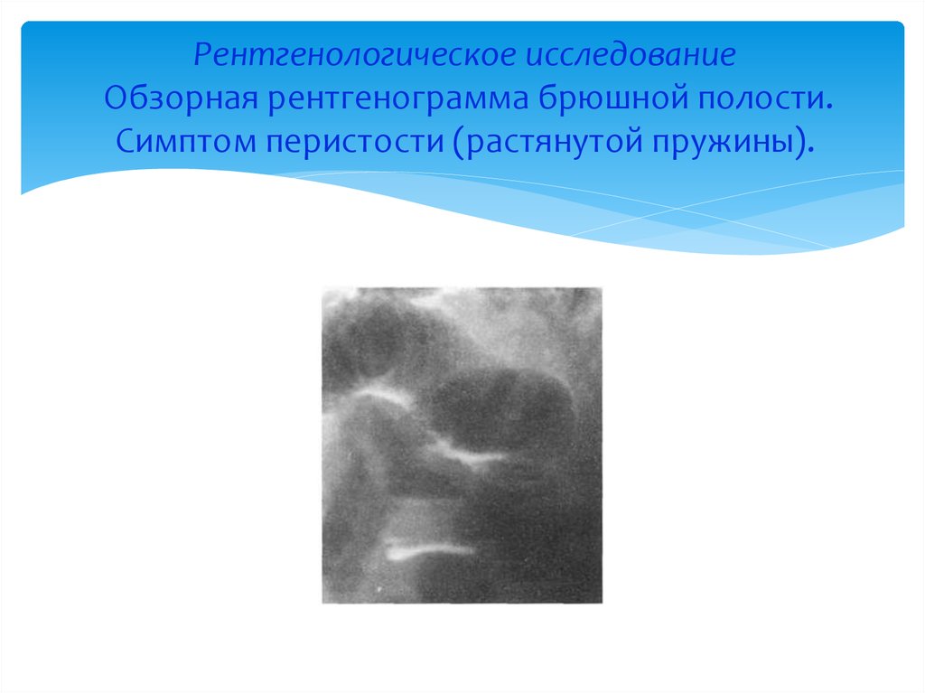 Полость признак. Рентгенологические симптом перистости. Протокол обзорной рентгенографии брюшной полости. Симптом перистости на рентгене. Симптом пружины на обзорной рентгенограмме.