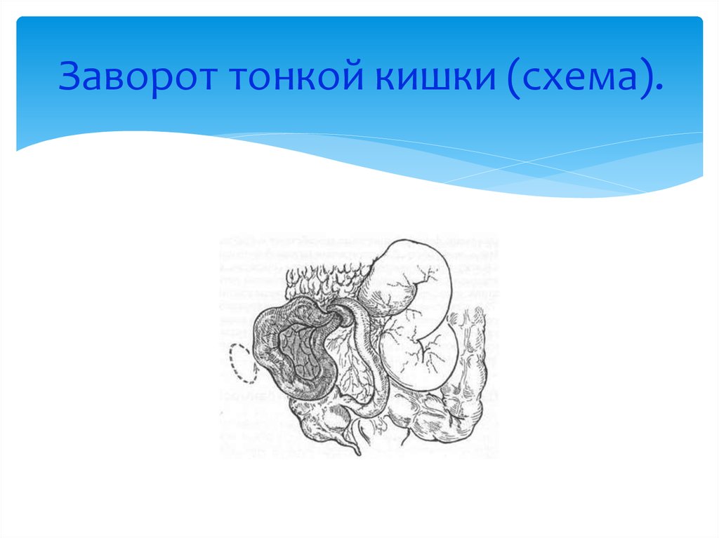 Обработка кишок схема