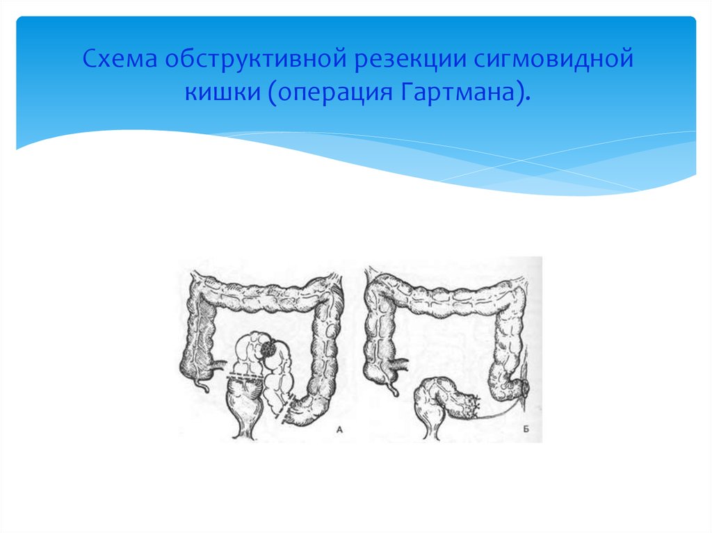 Схема операция гартмана