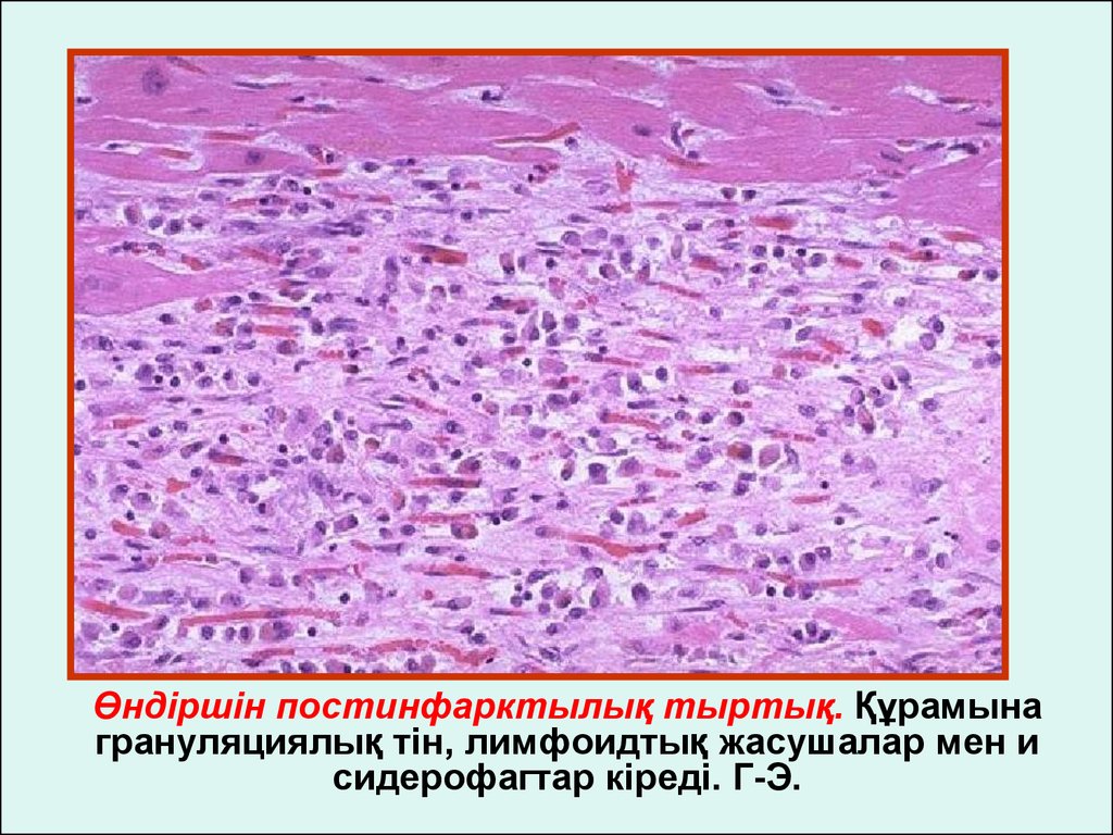 Грануляционная ткань. Грануляционная ткань патологическая анатомия. Грануляционная ткань патанатомия. Грануляционная ткань гистология. Грануляционная ткань патологическая анатомия препарат.