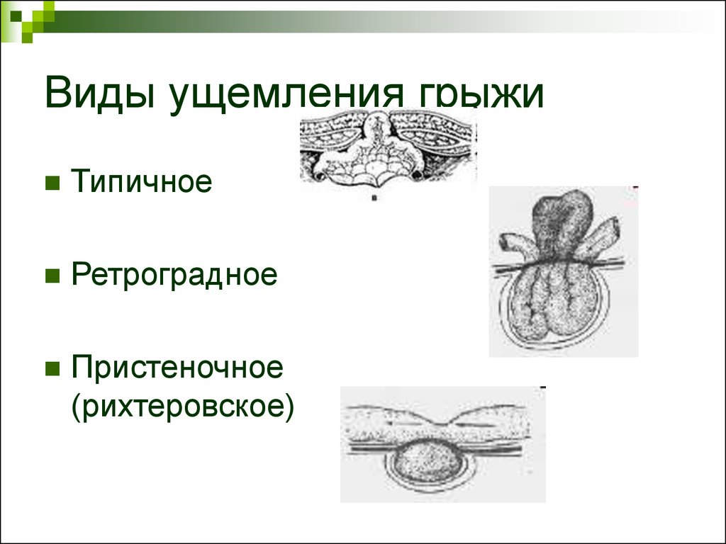 Какова клиническая картина при рихтеровском ущемлении