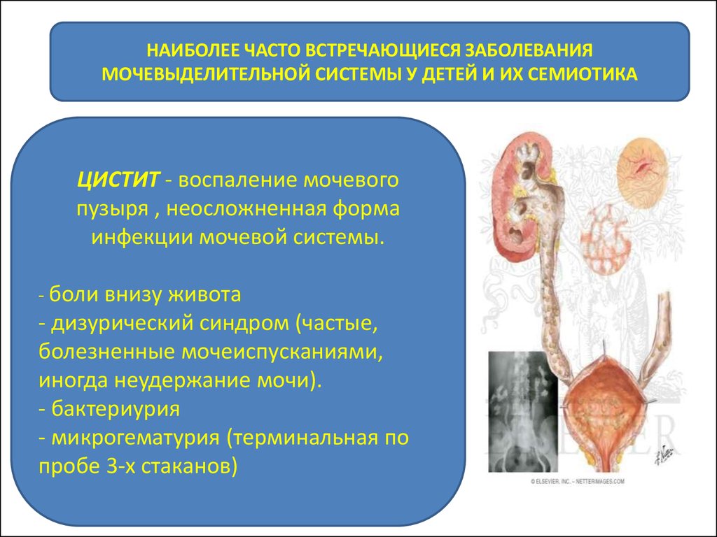 Заболевание цистит болезнь