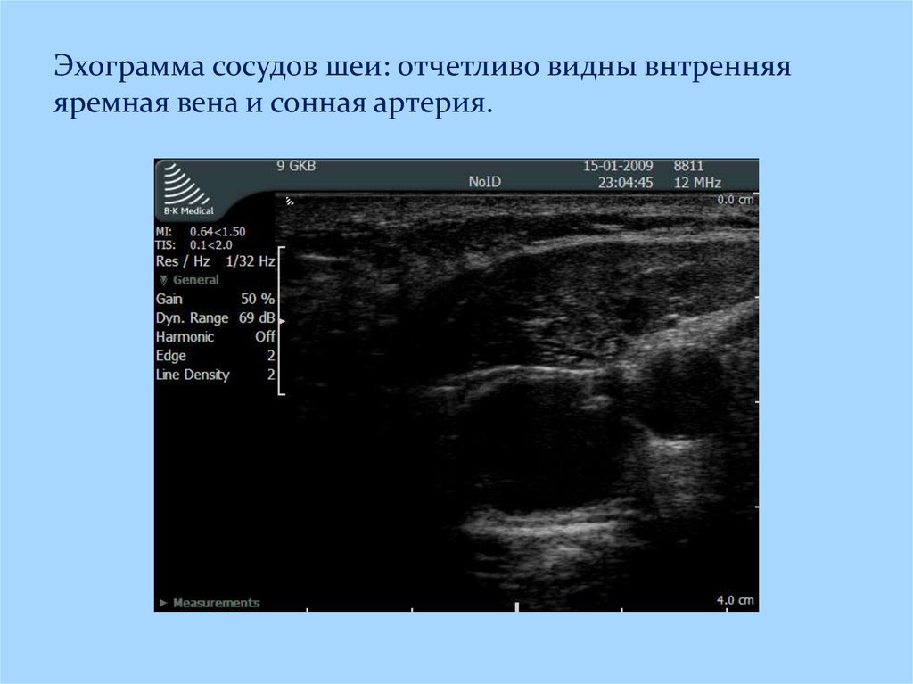 Узи вен видное. УЗИ внутренней яремной вены. Внутренняя яремная Вена на УЗИ. Наружная яремная Вена на УЗИ. Сосуды шеи УЗИ яремная Вена.