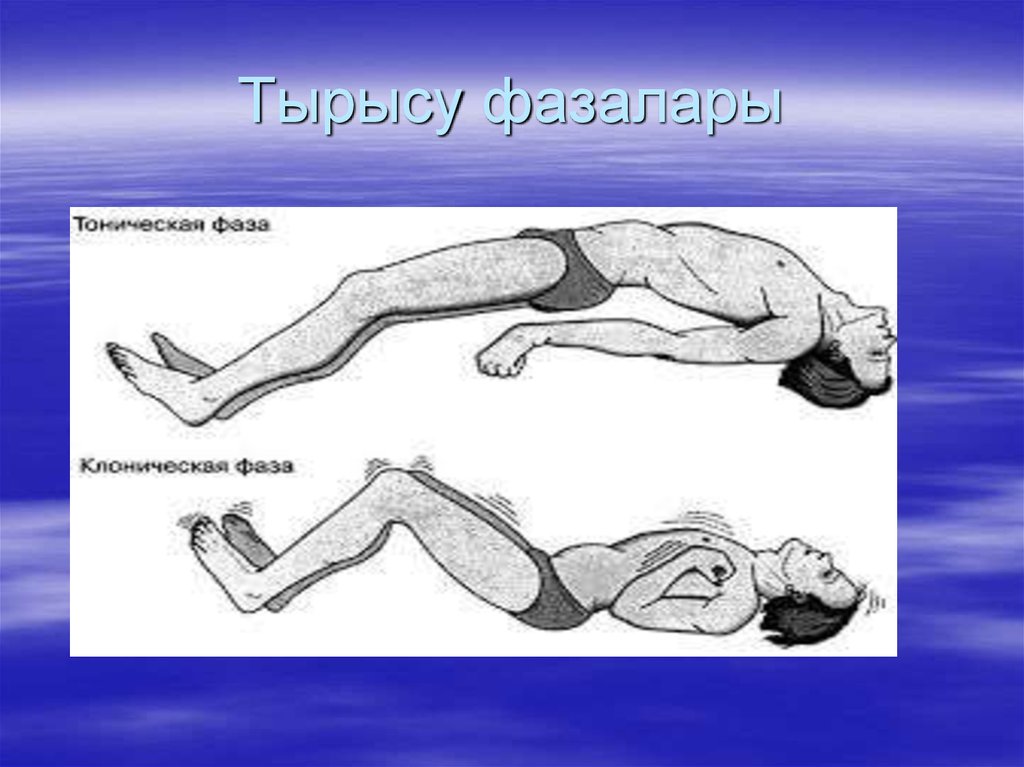 Тонические припадки