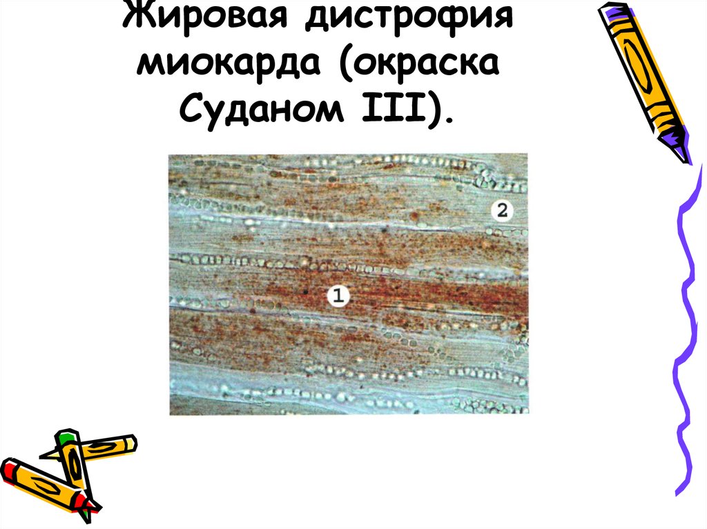 Жировая дистрофия миокарда (окраска Суданом III).