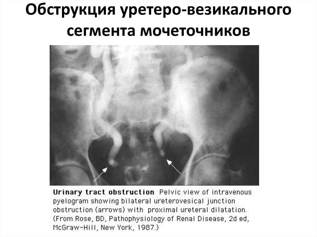 Лечение мочеточников у мужчин. Перешеек мочеточника. Непроходимость мочеточника. Ширина мочеточника в норме кт. Обструкция мочеточника.