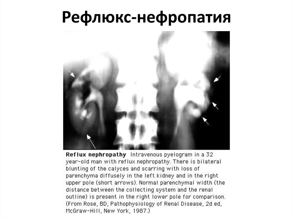 Рефлюкс нефропатия презентация