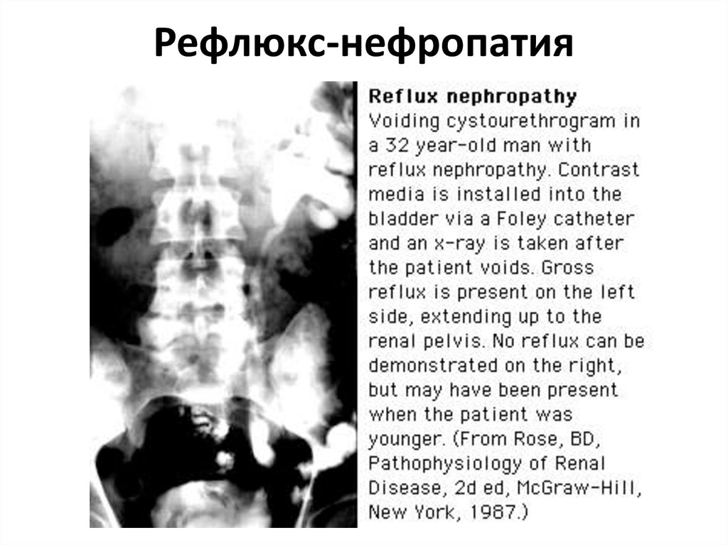 Рефлюкс нефропатия презентация