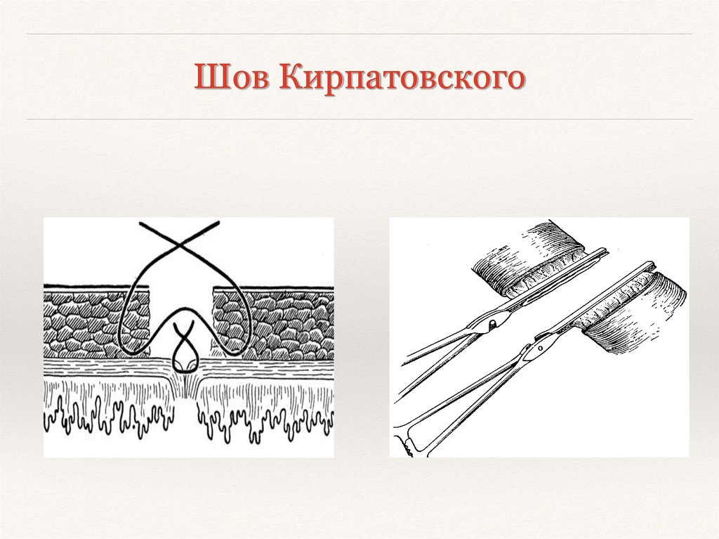 Кишечный шов презентация