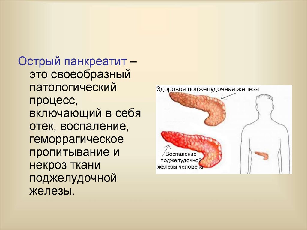 Остров панкреатит. Локализация острого панкреатита. Панкреатит острый панкреатит. Острый панкреатит поджелудочной железы. Острый отечный панкреатит.