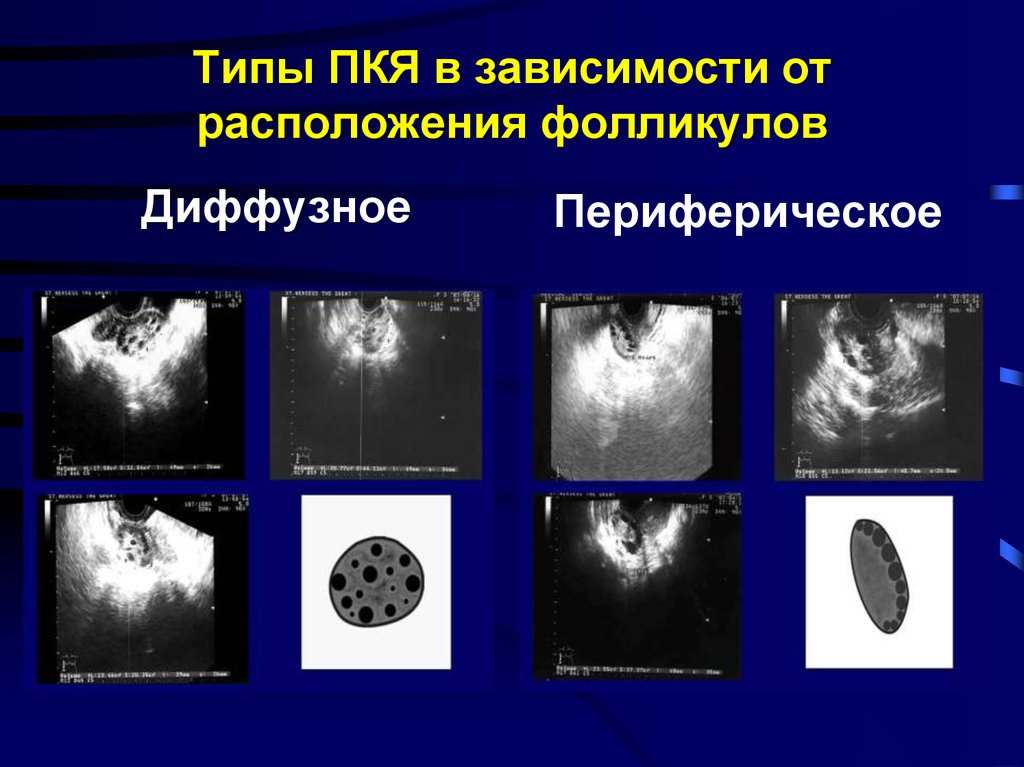 Диффузный тип. Диффузное расположение. Диффузное расположение фолликулов это. Диффузное расположение это как.