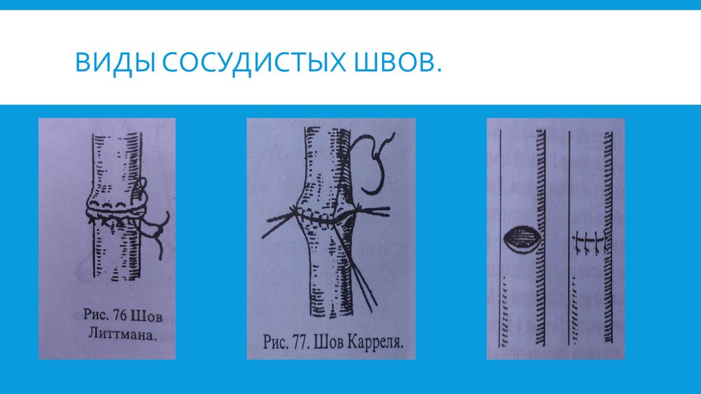 Сосудистый шов. Виды сосудистых швов. Боковой сосудистый шов.