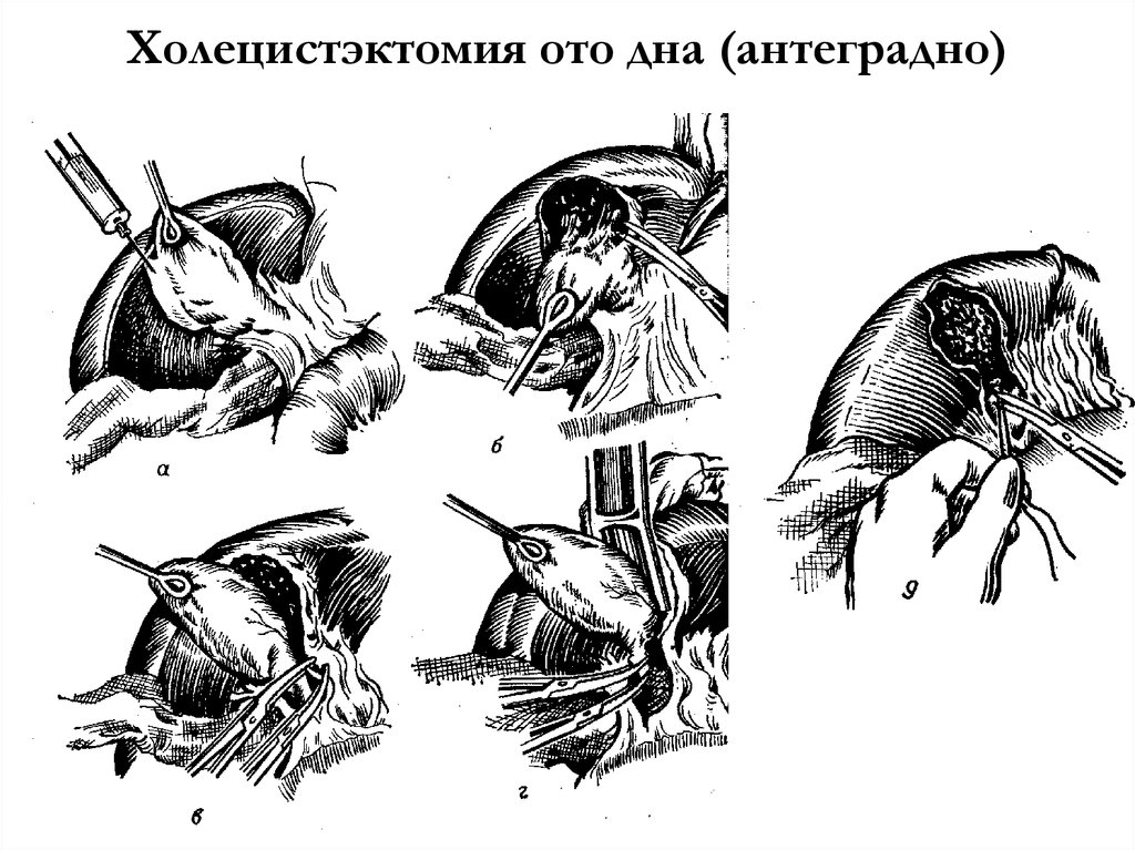 Субтотальная гистерэктомия презентация