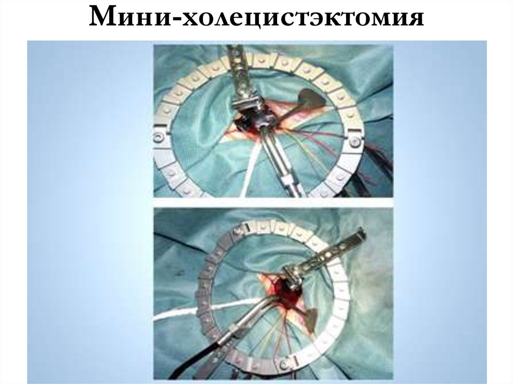 Мини-холецистэктомия