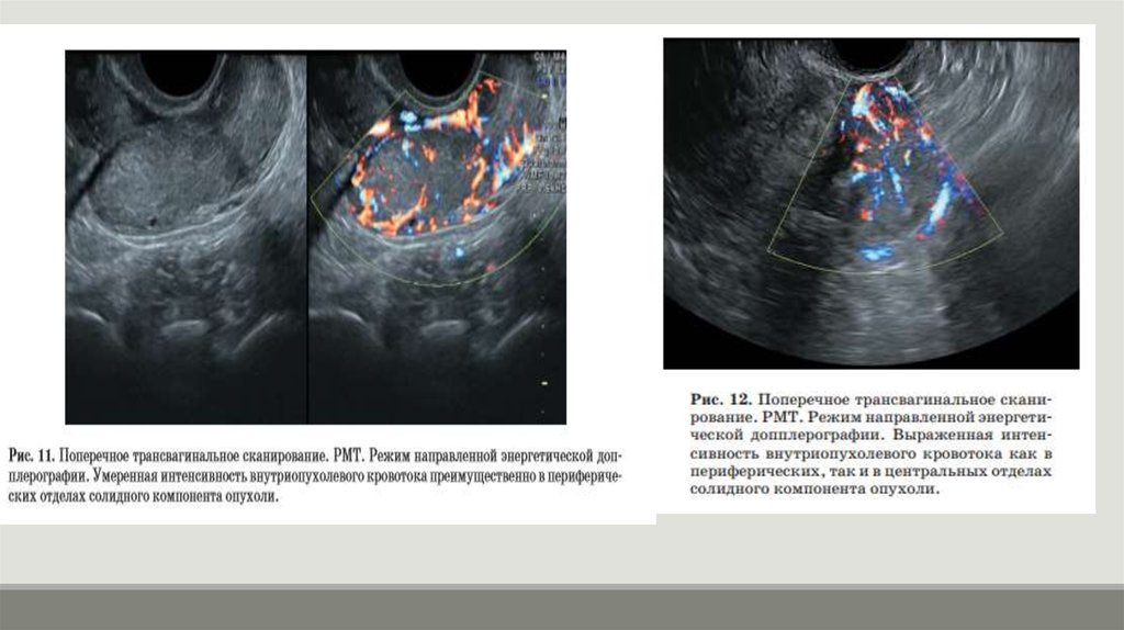 Узи труб. Солидный компонент опухоли что это. Онкология маточной трубы. Доброкачественные опухоли фаллопиевых труб.