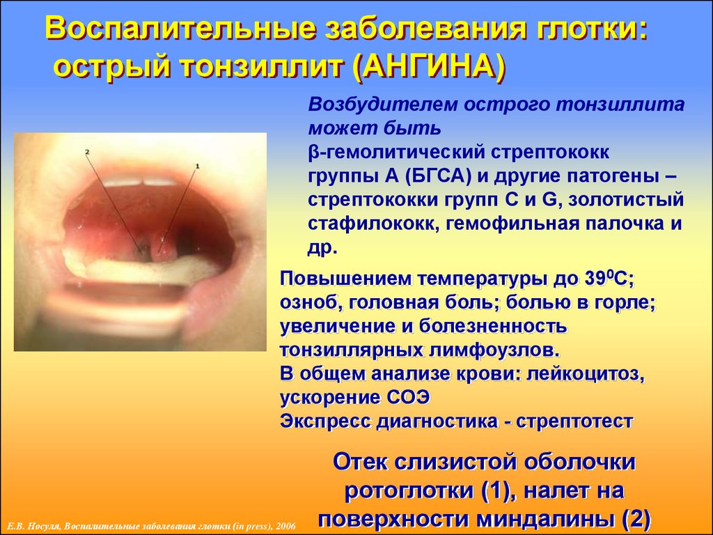 Острый тонзиллит у ребенка фото