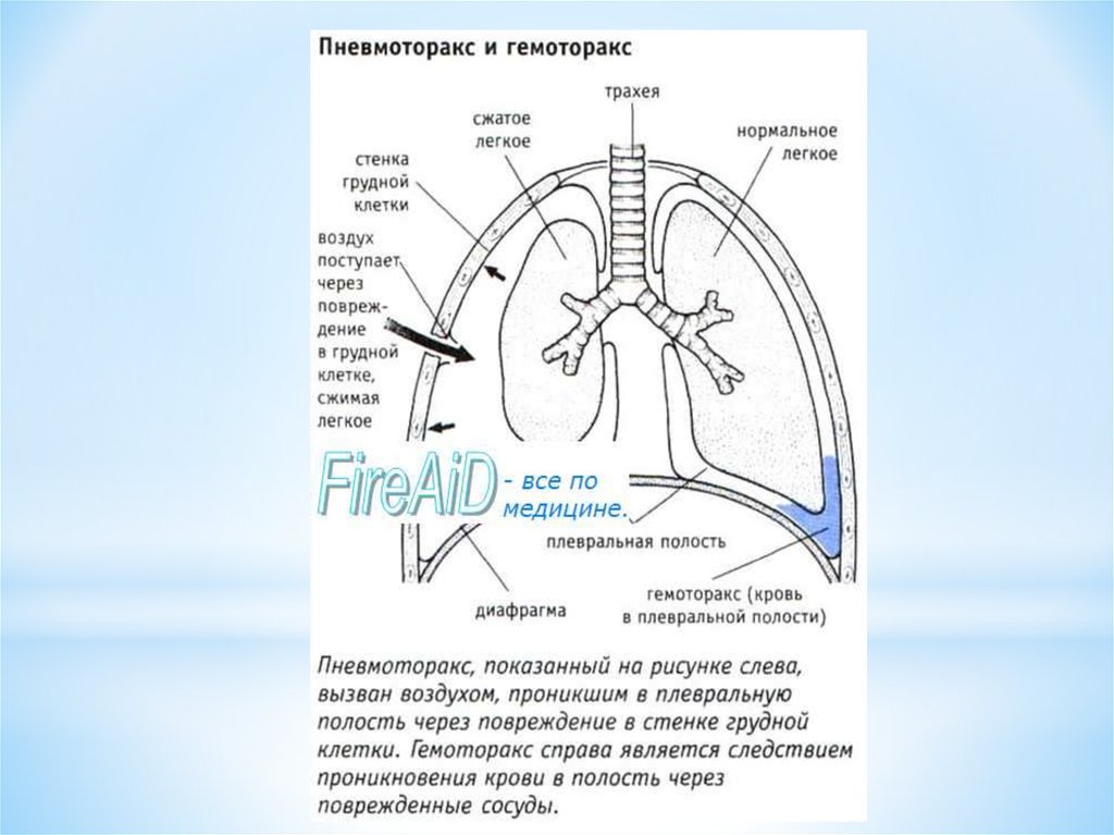 Презентация пневмоторакс и гемоторакс