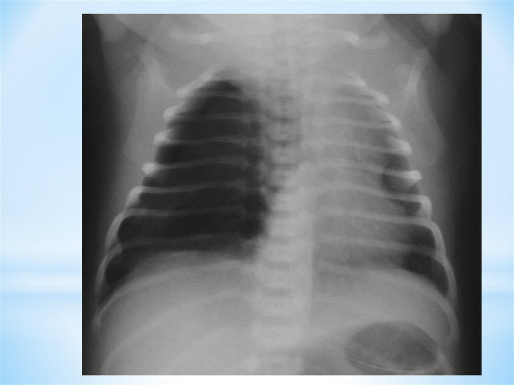 Ребенок после рентгена. Пневмоторакс у новорожденных рентген. Пневмоторакс у детей рентген. Пневмония новорожденных рентген. Пневмоторакс у новорождённого рентг.