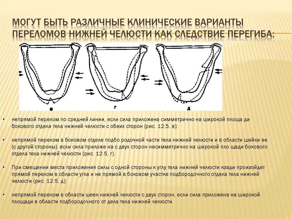 Механизмы перелома нижней челюсти